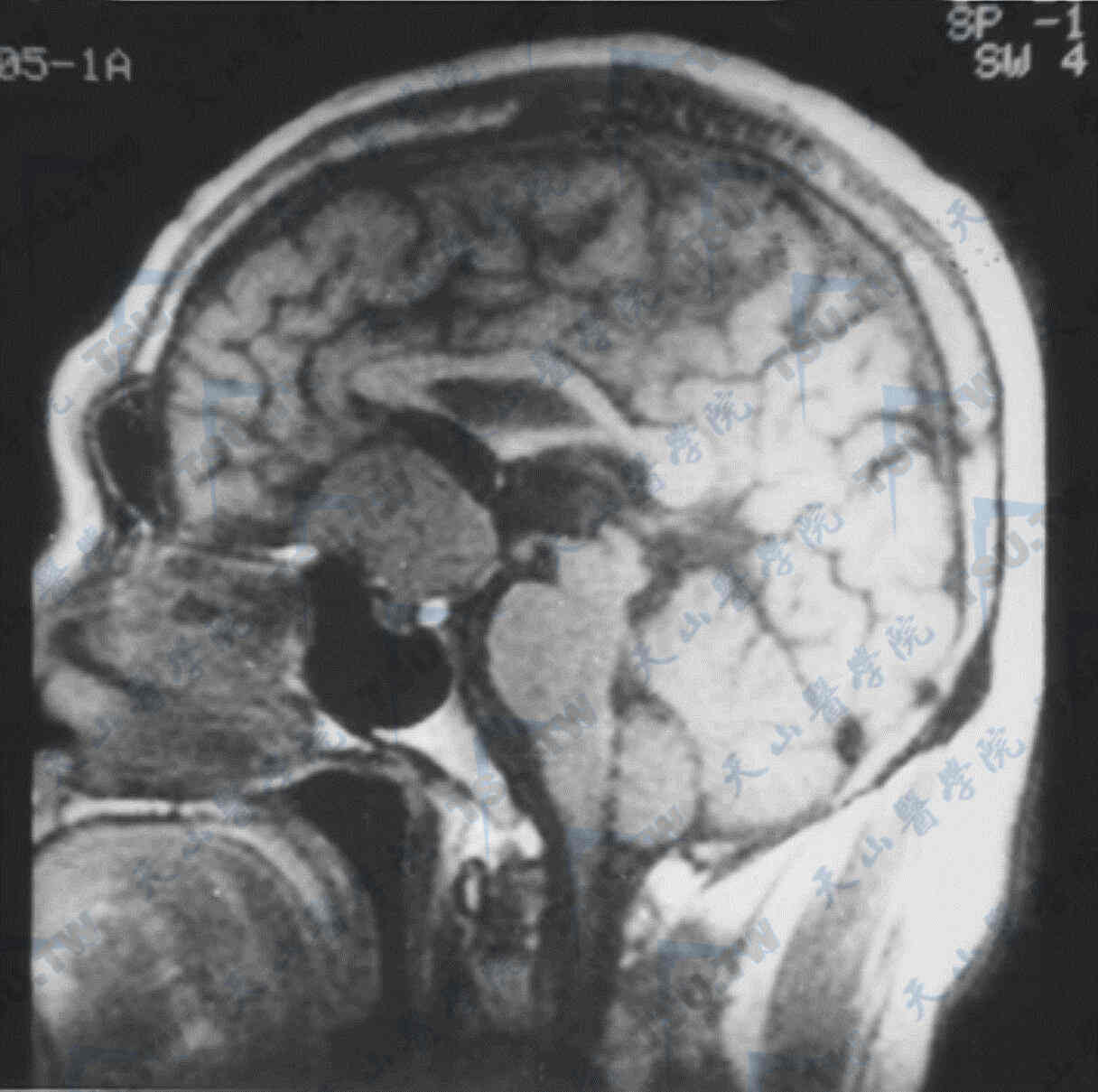 老年人侵袭性垂体瘤的症状、治疗及预防：案例分析与健康指南