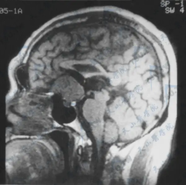 侵袭性垂体瘤患者围术期麻醉管理:如何平衡内分泌与神经系统风险?