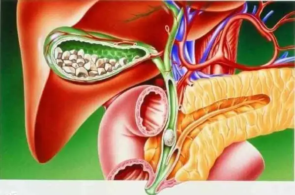 麻醉在胆囊切除术中的关键作用:如何确保手术安全?
