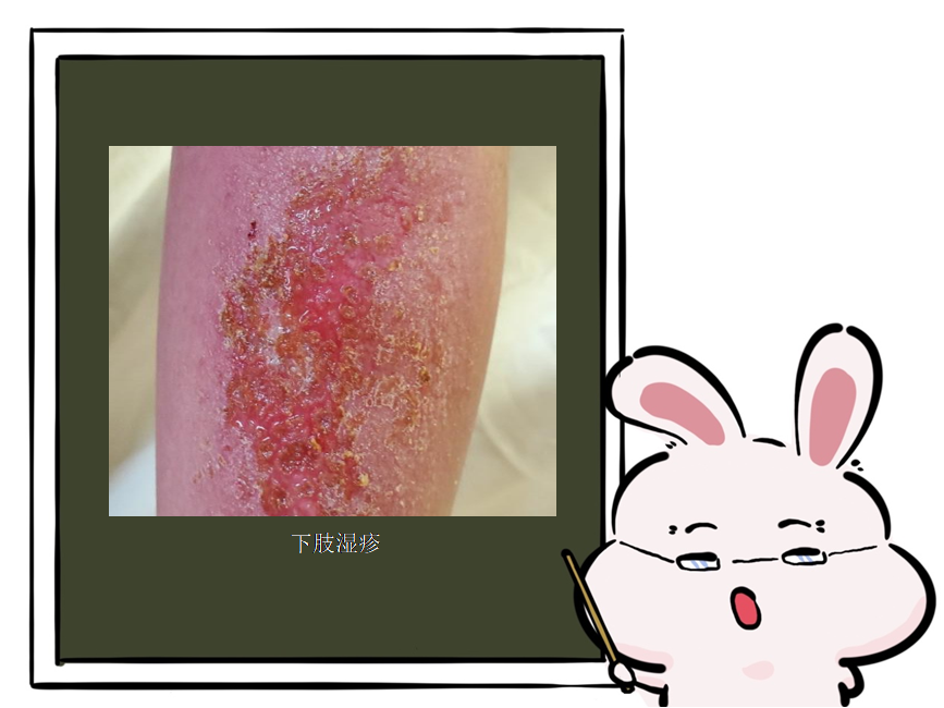特应性皮炎与湿疹：患者应该知道的对策与预防封面图