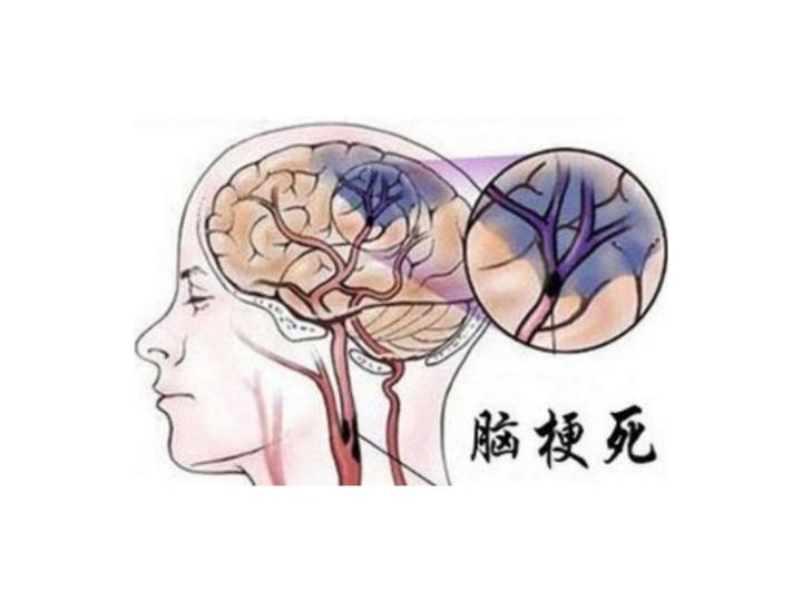 脑梗死？别担心！带您深入了解从症状到预防的完整指南