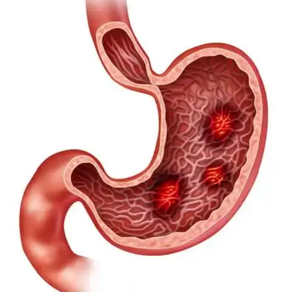 胃溃疡：症状、诊断与现代治疗探索
