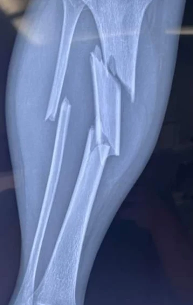 胫骨骨折的全面解析：从诊断到康复