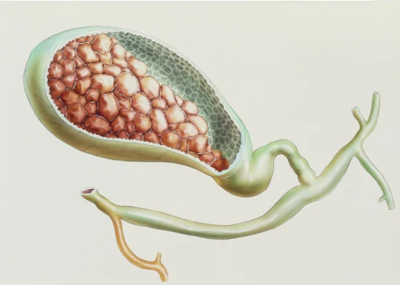 麻醉在胆囊切除术中的应用：如何确保手术安全与舒适？