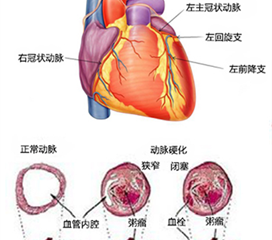 科普，冠状动脉粥样硬化性<span style="color: #da4707">心脏病</span>的全景解析：从<span style="color: #da4707">病因</span>到管理