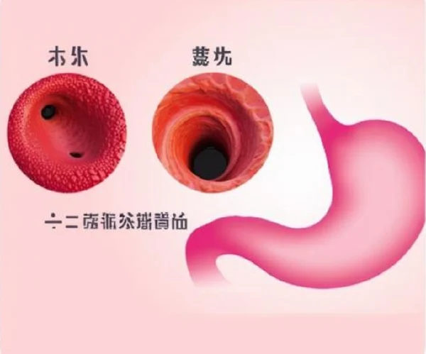 综合解读十二指肠溃疡伴出血的诊疗方法及管理策略