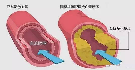 糖尿病合并高脂血症的综合管理：从诊断到治疗的全面指南封面图
