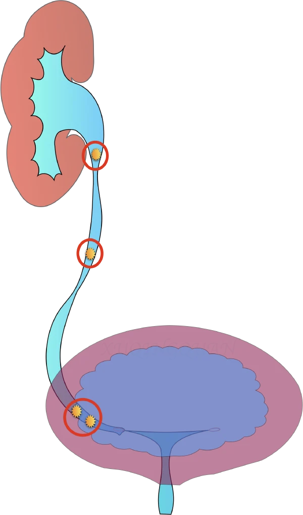 肾输尿管结石：综合诊断与治疗指南