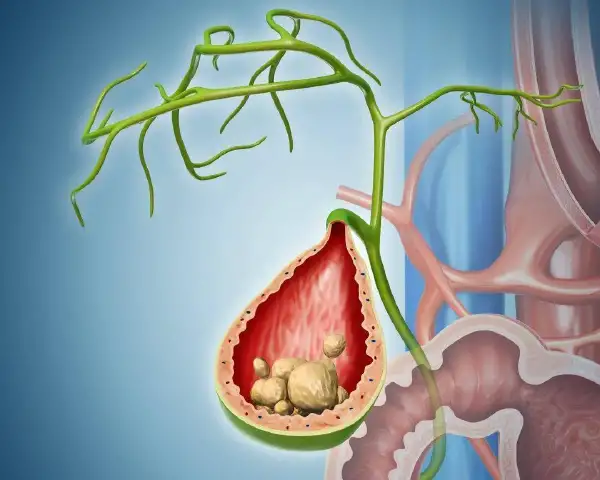 胆囊结石伴胆囊炎—中老年朋友注意了!