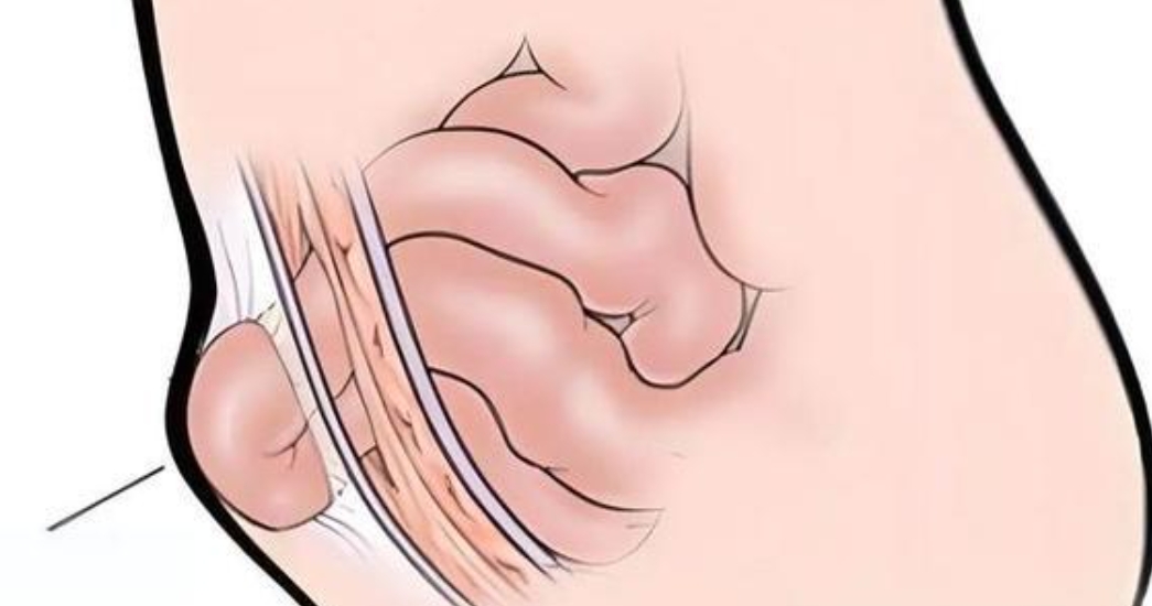 理解腹股沟疝及其科学管理方式