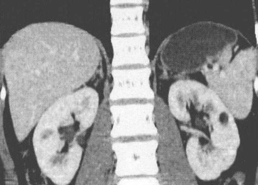 隐匿的危机——肾错构瘤与常见伴随疾患全解析！