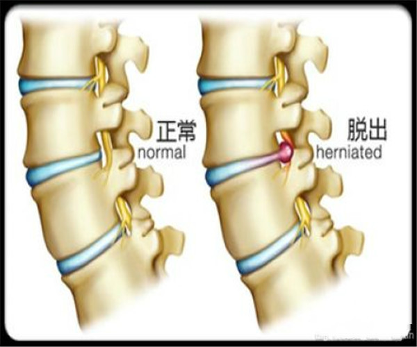 颈椎融合术与内固定装置去除：从手术到康复的全面解读