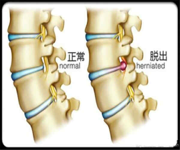 颈椎融合术与内固定装置<span style="color: #da4707">去除</span>：从手术到康复的全面解读