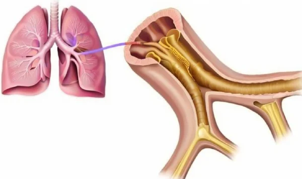 儿童急性气管炎:如何检测、治疗及预防