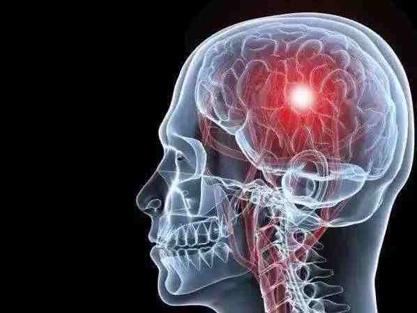 头痛与脑梗死后遗症：科学管理与规范治疗的双重视角封面图