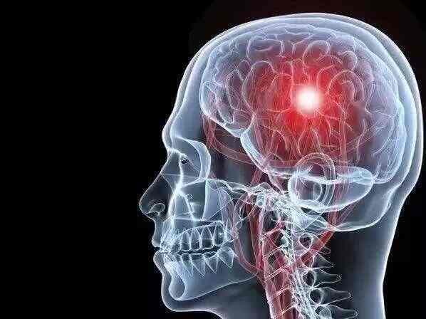 科普，头痛与脑梗死后遗症：科学管理与规范治疗的双重视角封面图