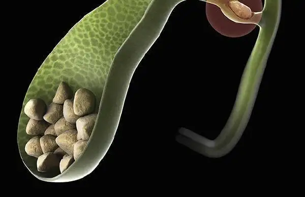 腹股沟疝及胆囊结石:诊断、治疗及管理