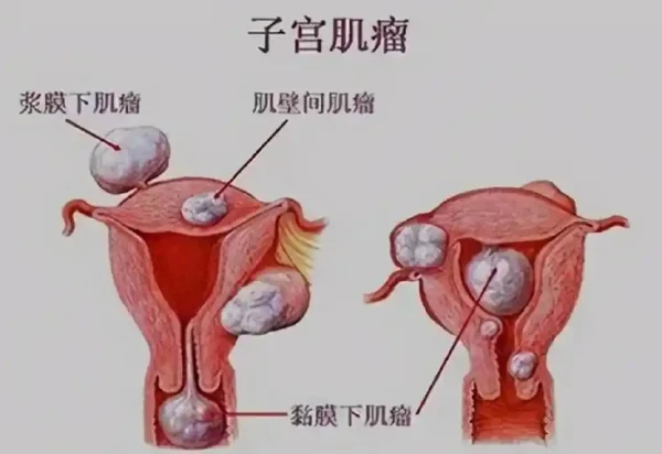 震惊！子宫肌瘤可能影响你的生活质量，快了解子宫肌瘤及预防措施！