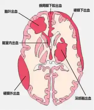 全面了解蛛网膜下腔出血与颈内动脉瘤：诊断与治疗的最新进展