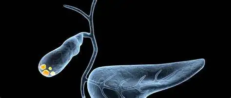 胆囊结石和慢性胆囊炎：你需要知道的一切！