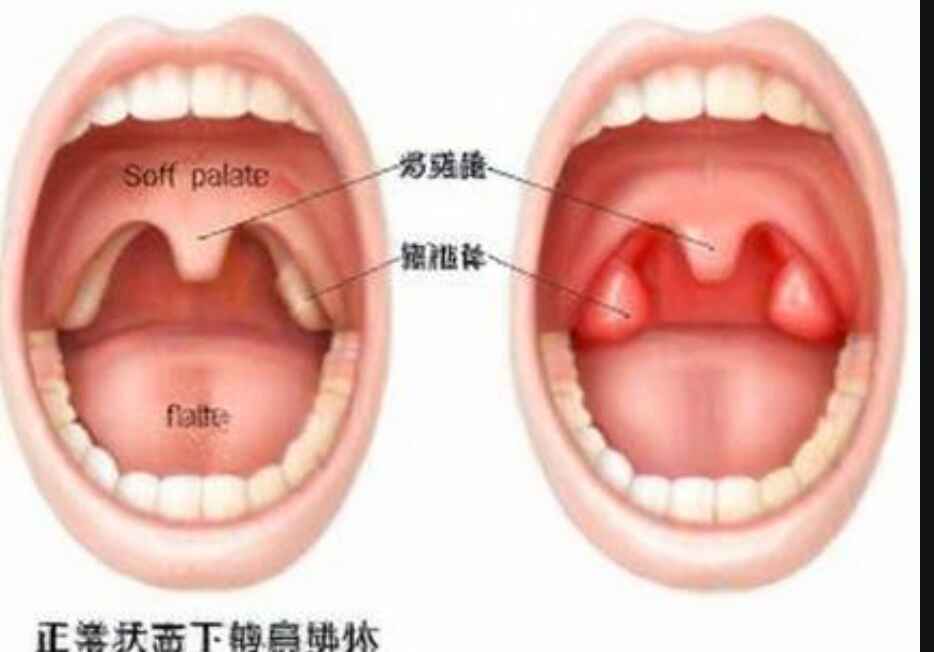 科普，<span style="color: #da4707">慢性</span><span style="color: #da4707">扁桃体炎</span>：从疾病认知到<span style="color: #da4707">治疗</span>管理全解读