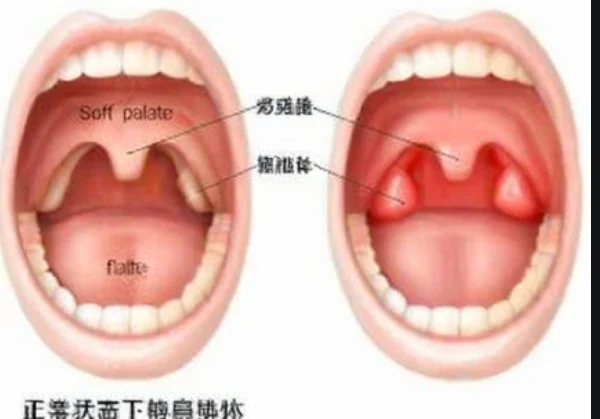 慢性扁桃体炎：从疾病认知到治疗管理全解读