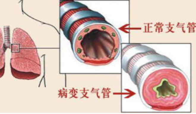 心功能不全及急性支气管炎：您需要了解的一切