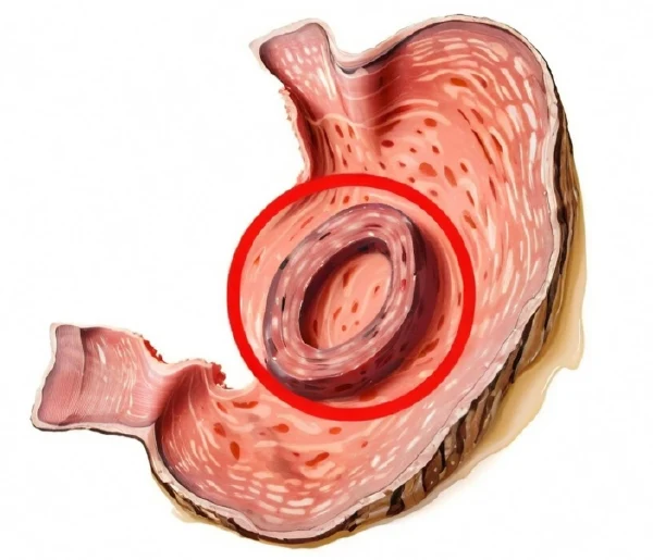 慢性胃窦炎的全面剖析与管理策略
