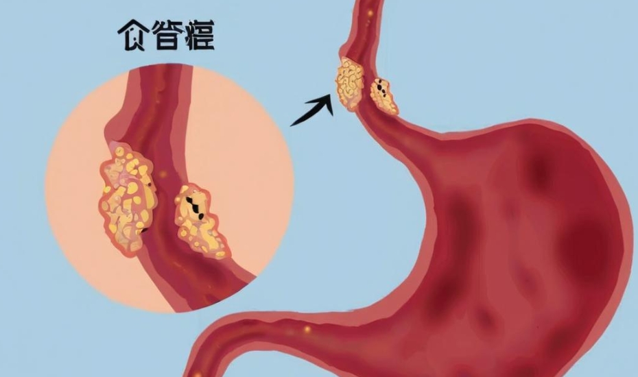 全面了解食管疾病：从诊断到治疗