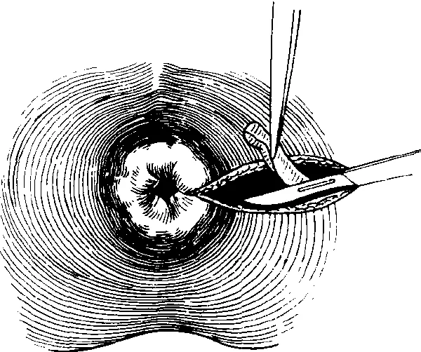 肛周脓肿:隐藏的隐患,需要您的特别关注