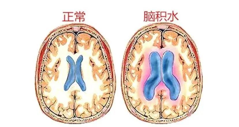 全面了解与管理慢性脑积水和肺炎