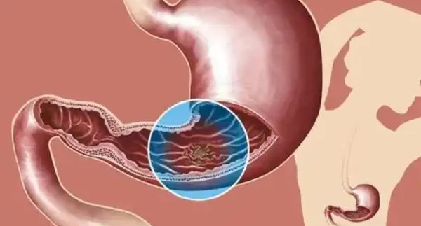 胃脘痛与慢性胃炎：原因、诊断及治疗详解