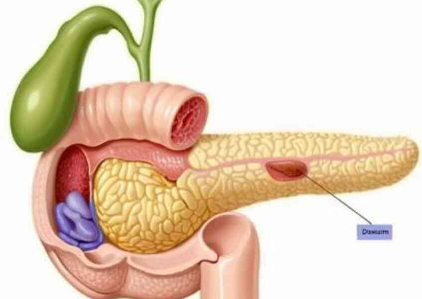 深度解析胰腺癌：诊断与治疗之路封面图