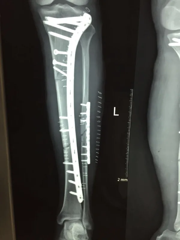 胫腓骨骨折的全面解析：从病因到康复的科学管理方法