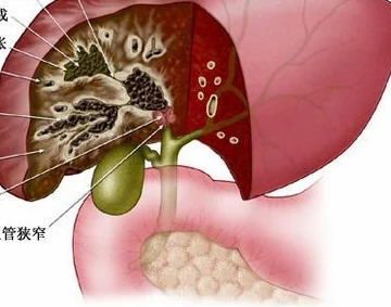关注肝内胆管结石——如何防治,老年人应该知道的那些事儿!