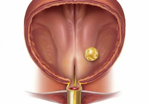 岁数不是问题，健康才是！——70岁患者膀胱结石解析与预防
