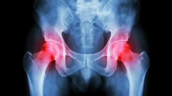 全麻与神经阻滞：股骨头坏死手术中的麻醉选择