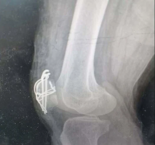 髌骨骨折:从受伤到康复的全过程