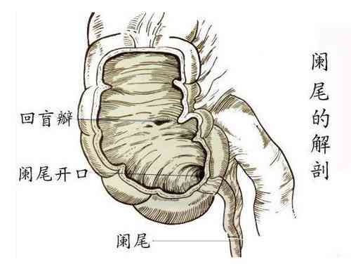 急性阑尾炎：全面解析、诊断与治疗方法