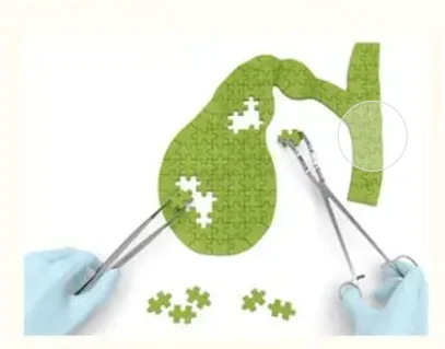 胆囊结石伴胆囊炎:从诊断到治疗,你需要了解的一切