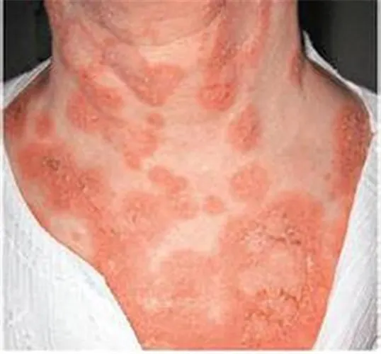 系统性红斑狼疮与反流性食管炎—你需要知道的一切!