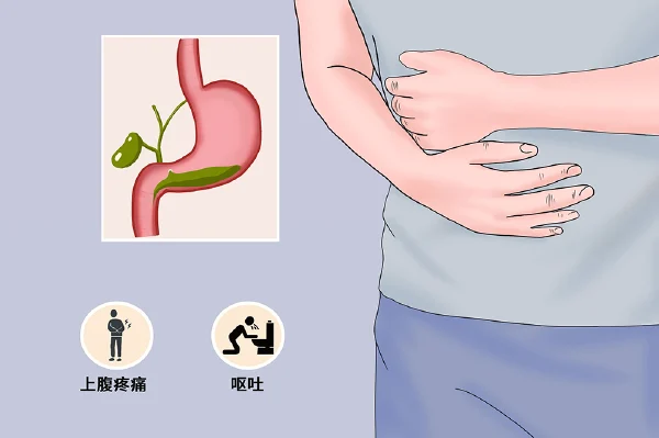 深度解析慢性胆汁反流性胃炎：病因、诊断与治疗全攻略