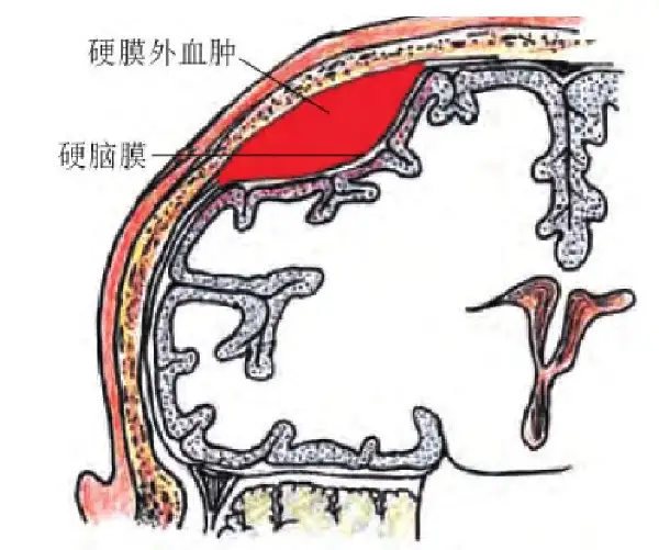 这些疾病你了解吗？硬膜外血肿、缺血性心肌病以及上肢动脉闭塞——一篇读懂!