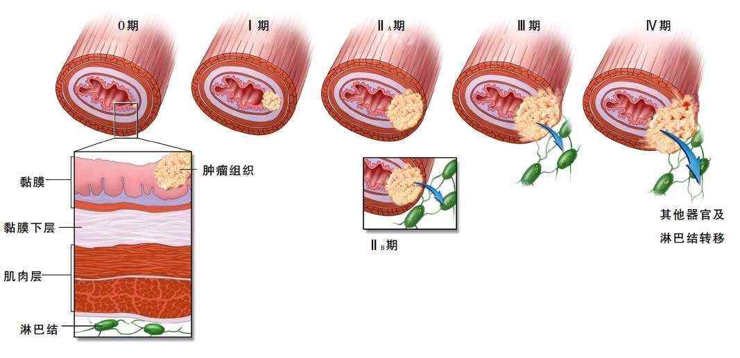 科普，食管黏膜不<span style="color: #da4707">典型</span>增生的全面解析：从诊断到治疗