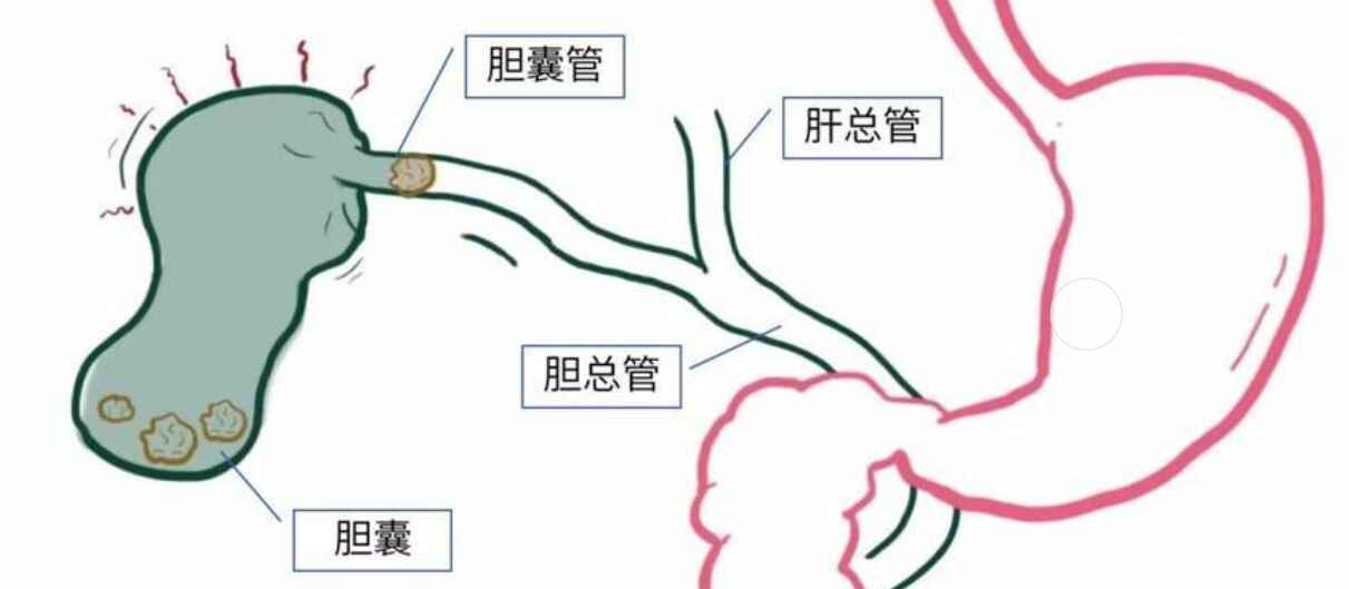 科普，胆囊结石与慢性胆囊炎：如何预防这些常见但棘手的问题封面图