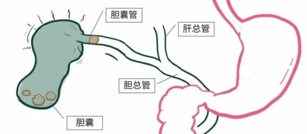 胆囊结石与慢性胆囊炎：如何预防这些常见但棘手的问题
