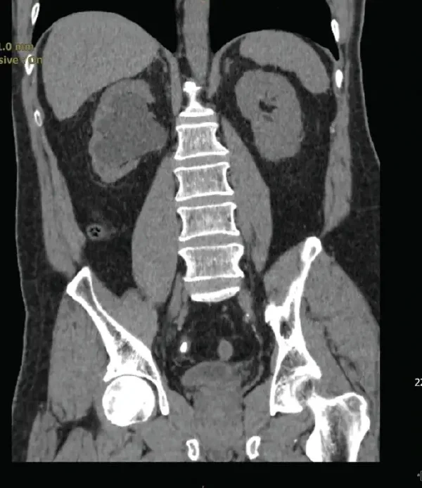 小心!腰背部疼痛可能是泌尿系结石的预兆!