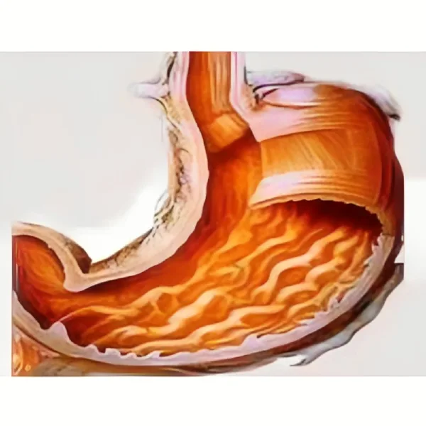 慢性胃炎的科学管理：从诊断到治疗的全面指南