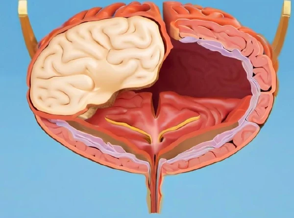 全面解读膀胱癌：从诊断至治疗
