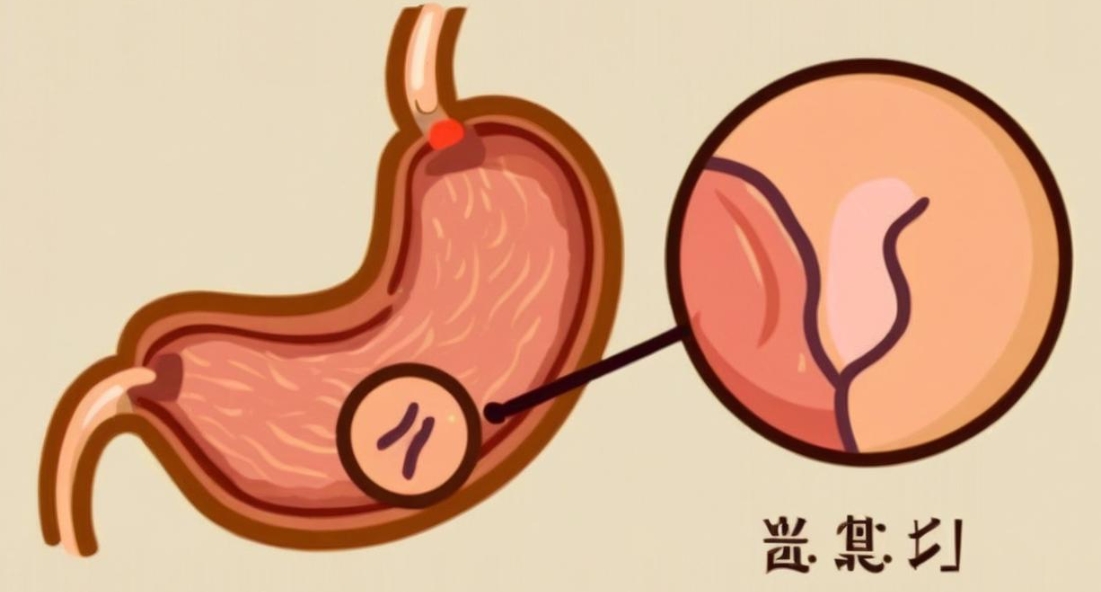 胃息肉管理全攻略：诊断、治疗与日常护理